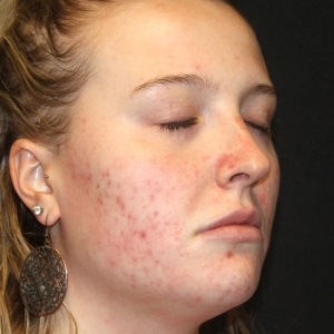 Before Acne Agnes_RMD A woman with acne prior to her Agnes RF treatment
