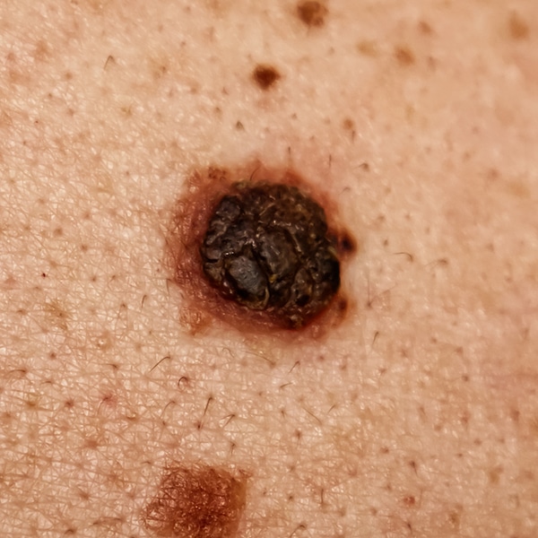 Before Mole Removal Harmless big mole on man's back.