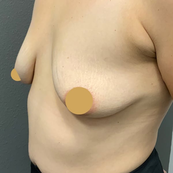 Before-Nonsurgical-Breast-Lift