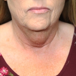 Before PDO thread lift Sagging neck prior to the PDO thread neck lift.