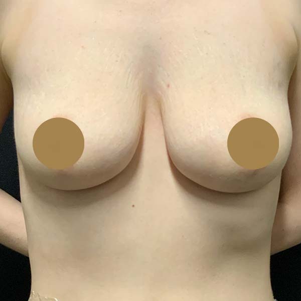 Before Vampire Breast Lift