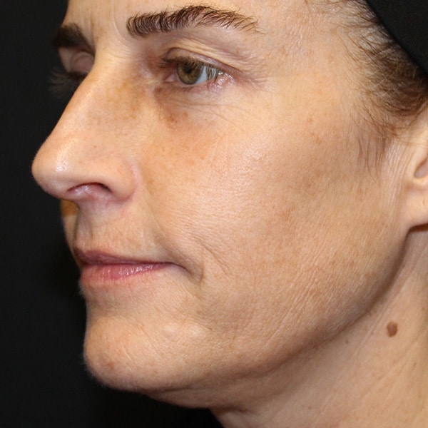 Sculptra before photo
