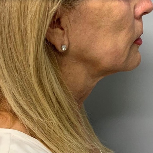 Before Sofwave | RejuvenationMD | Seattle | Bellingham | Burlington after