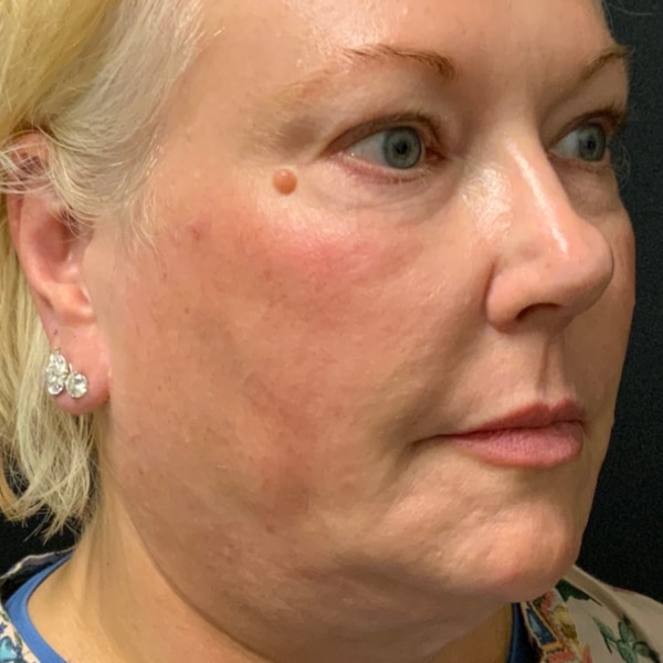 Before Nonsurgical Facelift