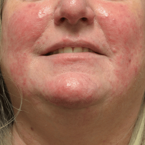 Before rosacea-BBL inflamed rosacea