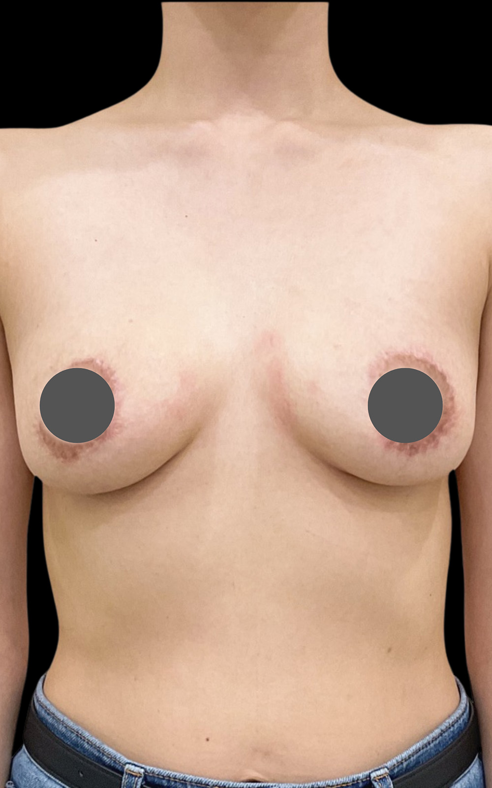 6 months after agnes ultra treatment