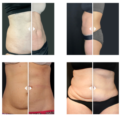 Before and After CoolSculpting® treatment by RejuvinationMD
