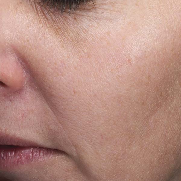 Moxi Laser after After Moxi Laser woman melasma is cleared