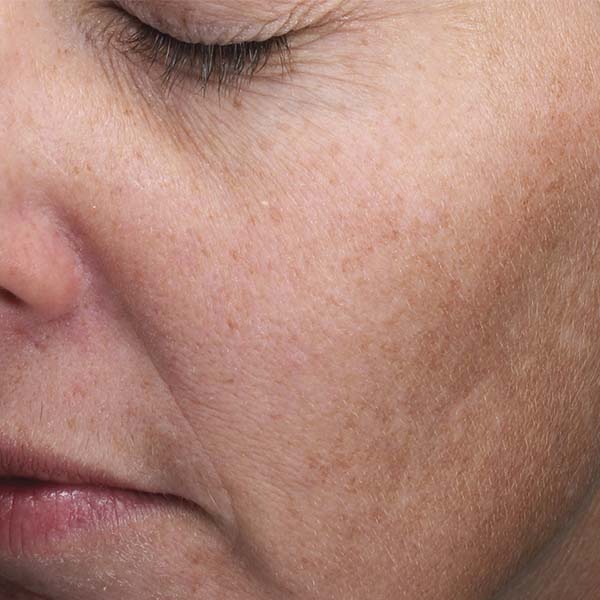 Moxi Procedure Before