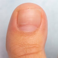 Nail Fungus After Healthy big toe and nail