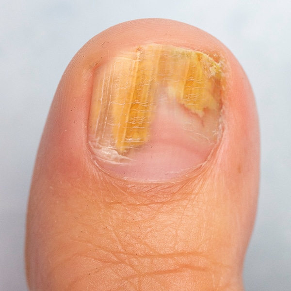 Nail Fungus before big toe with fungus on the toe nail