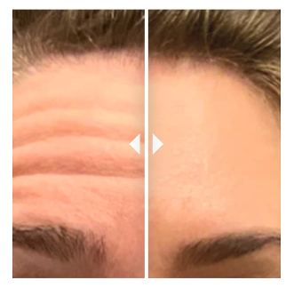 Patient's forehead before and after BOTOX® Cosmetic by RejuvenationMD®