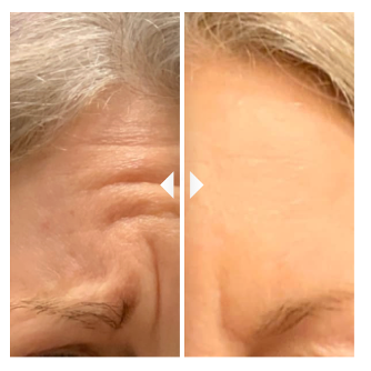 Patient's forehead before and after BOTOX® Cosmetic by RejuvenationMD®