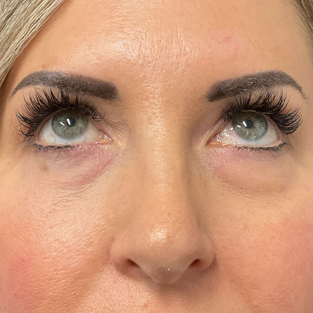 RMD_2 Agnes RF Eyes_after Agnes-RF-Eyes_after