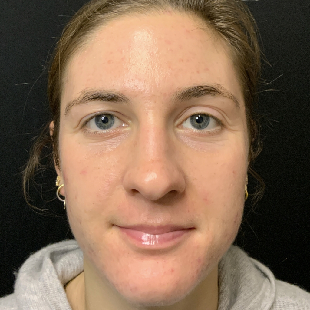 RMD_After 4 Chemical Peels Acne is gone after 4 chemical peels