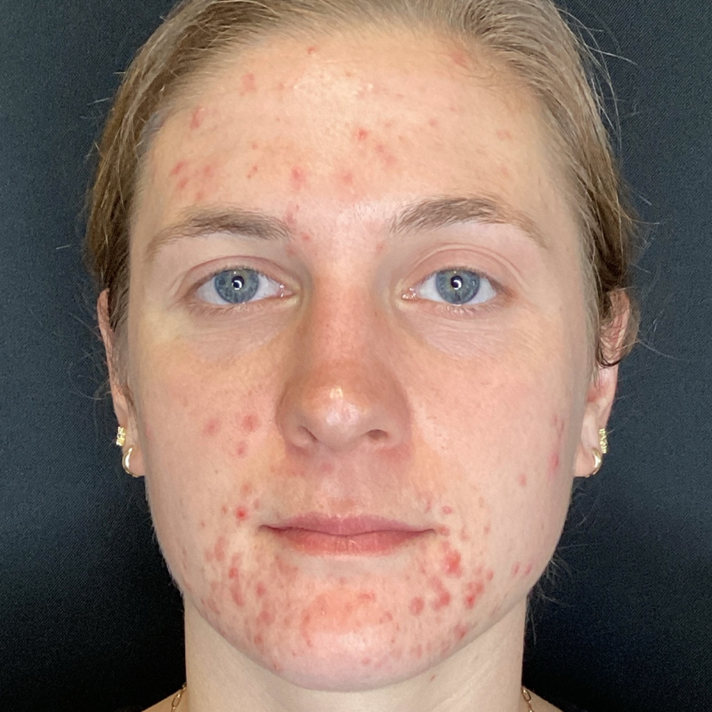RMD_Before 4 Chemical Peels girl with bad acne