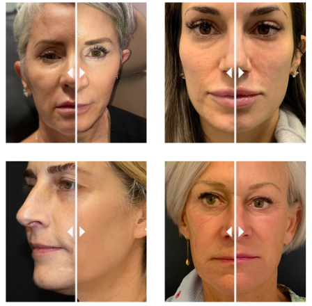 Before and After Sculptra® Aesthetic treatment 