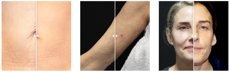 Before and After SkinTyte II™ treatment 