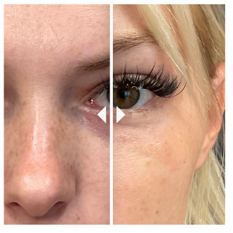 Before an After Under Eye Filler at RejuvenationMD®