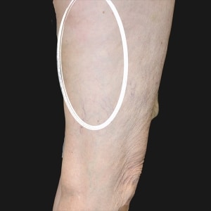Z Wave After After Z Wave treatment smooth cellulite free leg