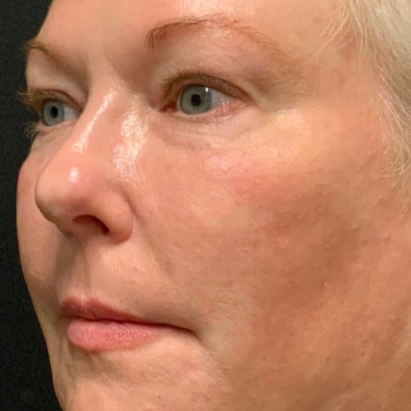 After Nonsurgical Facelift