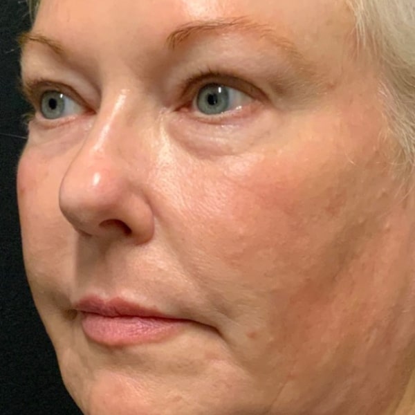 Before Nonsurgical Facelift
