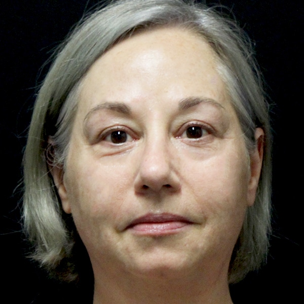 Scarlet SRF & Agnes RF 8 Radio Frequency Skin Tightening Before and After | After Picture