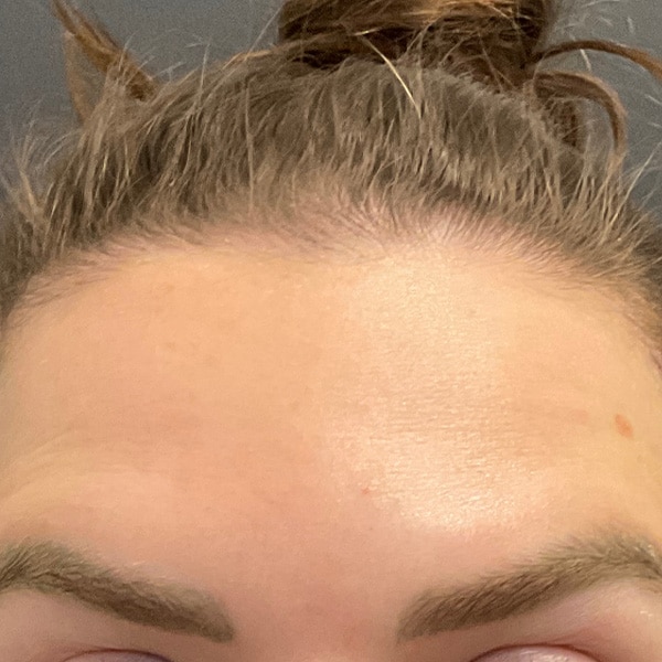 Botox® & Xeomin® 10 After