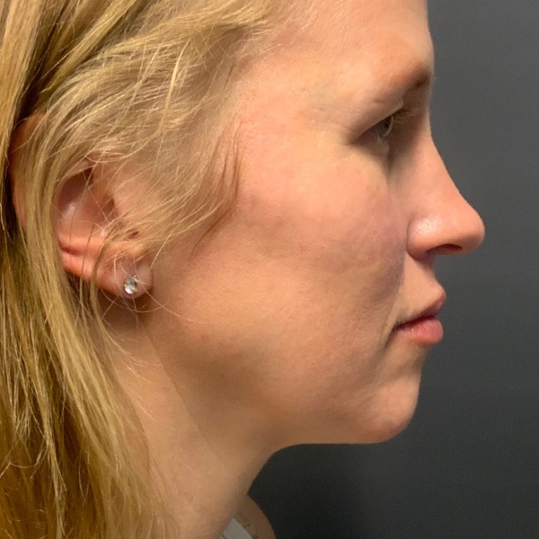 Dermal Fillers 20 After full face filler
