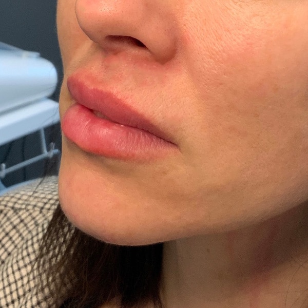 Dermal Fillers 16 After Lip Filler