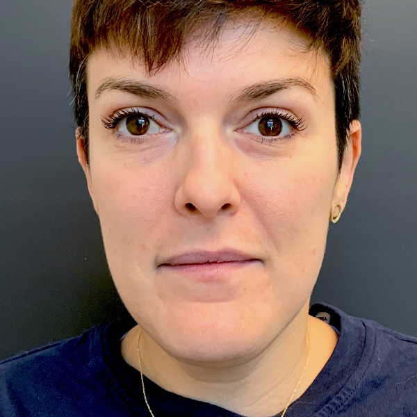 Laser Resurfacing 4 After Moxi