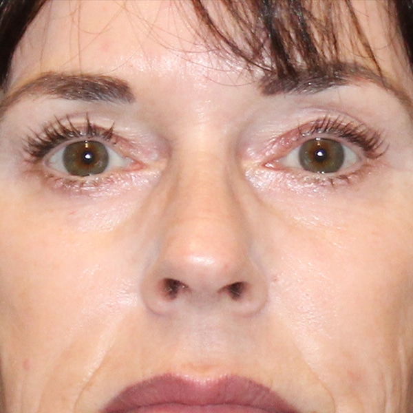 woman with tighter eye skin after plasma pen