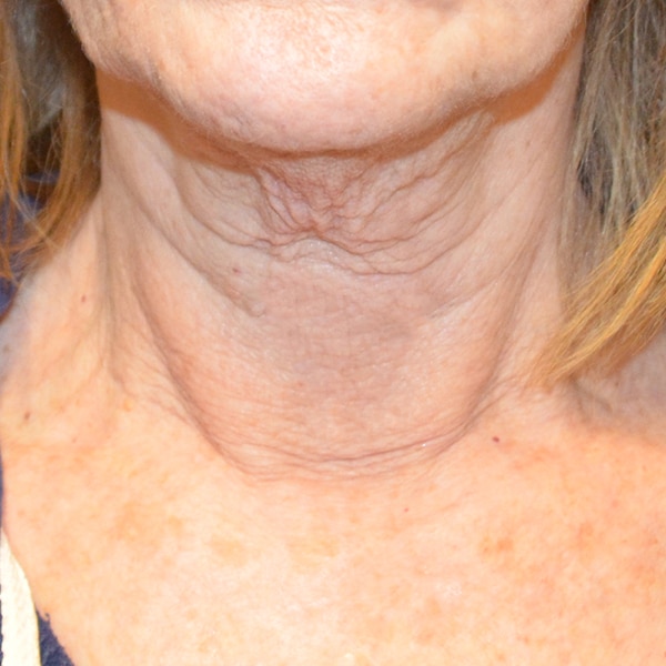 Rejuvapen™ NXT Microneedling 4 After