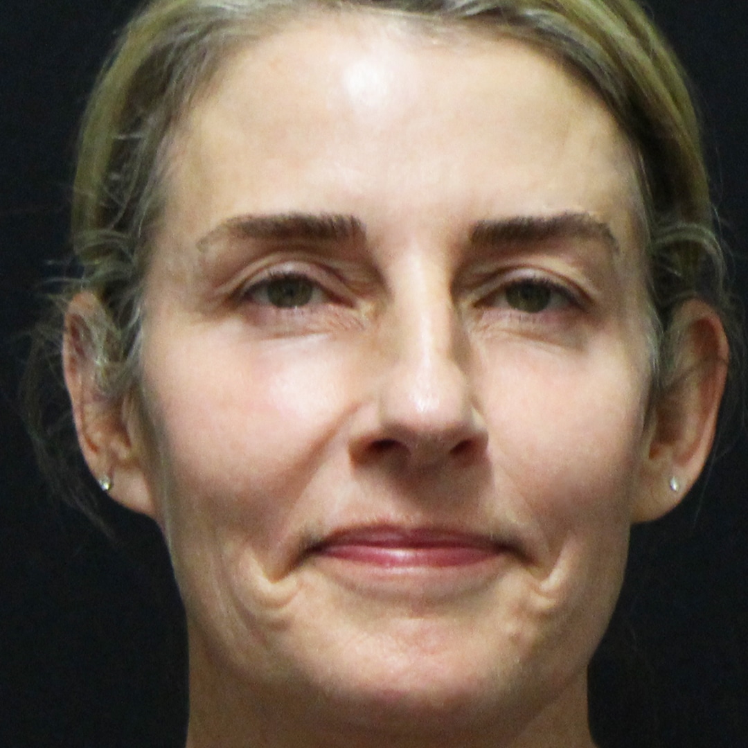 Sculptra® Aesthetic Gallery 4 After
