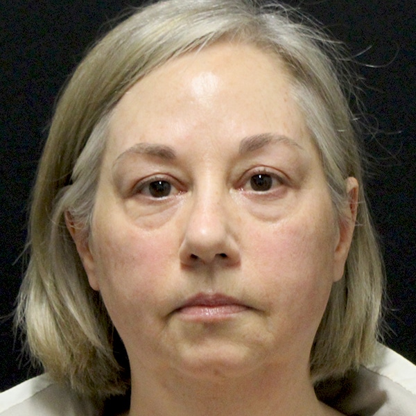 Scarlet SRF & Agnes RF 7 Radio Frequency Skin Tightening Before and After | Before Picture