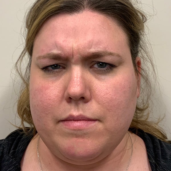 Botox® & Xeomin® 15 Before