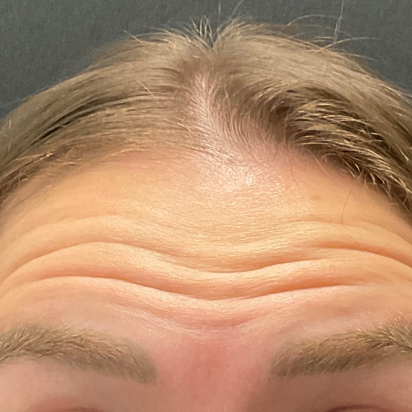 Botox® & Xeomin® 9 Before