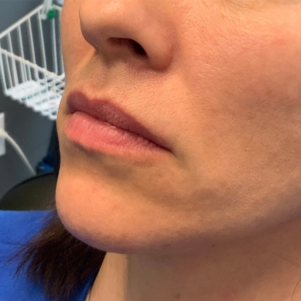 Dermal Fillers 15 Before Lip Filler