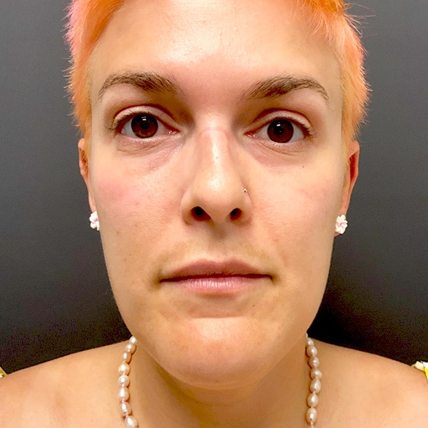 Laser Resurfacing 3 Before Moxi