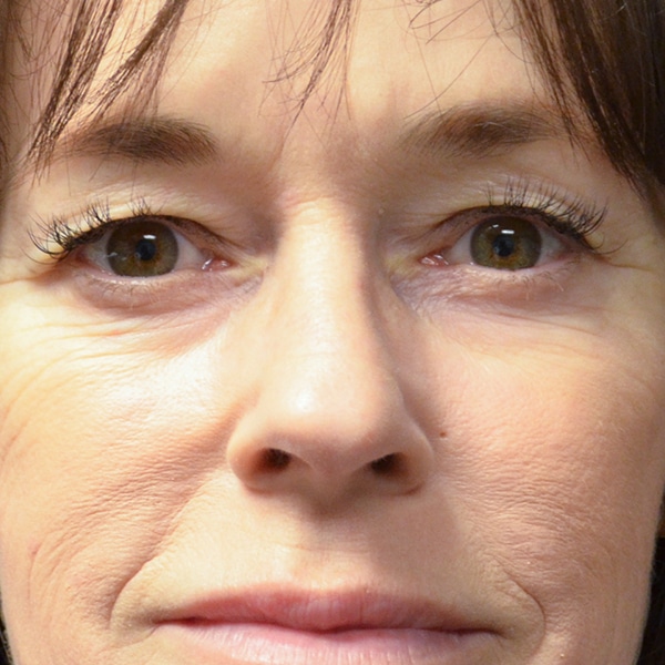 woman with eye wrinkles