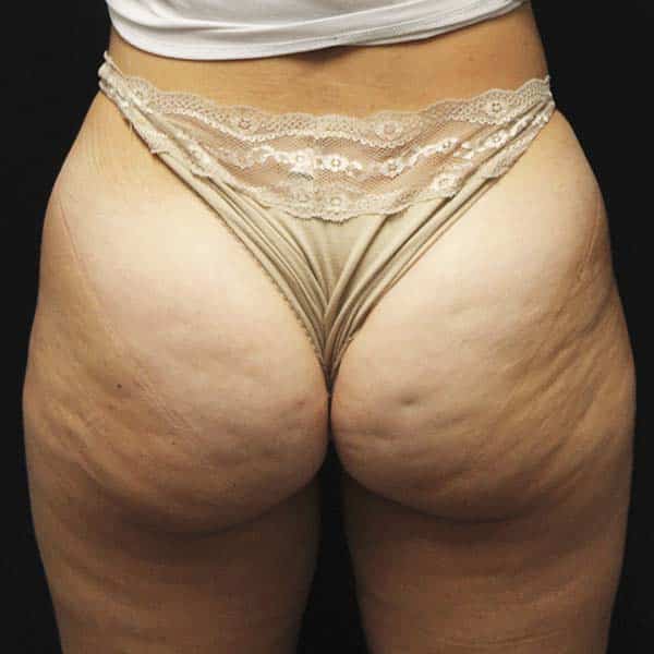 Before QWO + CoolTone Buttocks Treatment