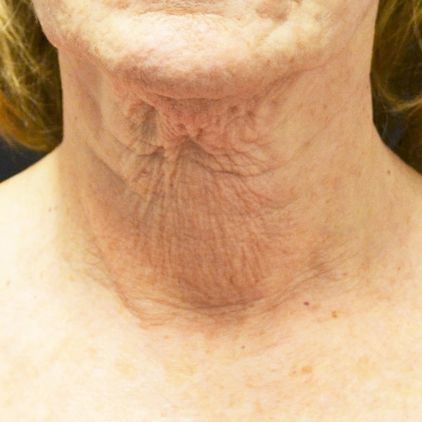 Rejuvapen™ NXT Microneedling 3 Before
