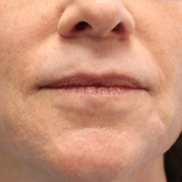 Laser Resurfacing 22 After