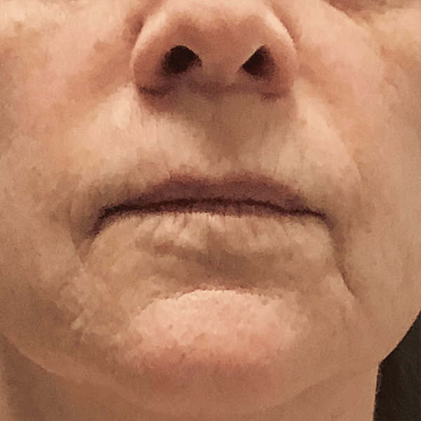 Laser Resurfacing 21 Before