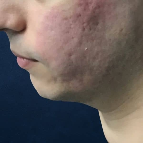mans profile, before microneedling treatment acne scarring