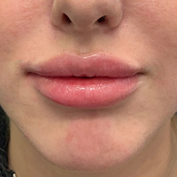 Dermal Fillers 36 After