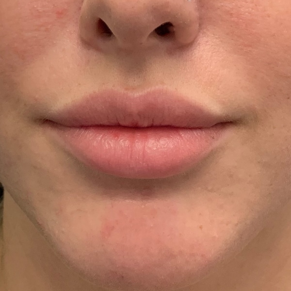 Dermal Fillers 35 Before