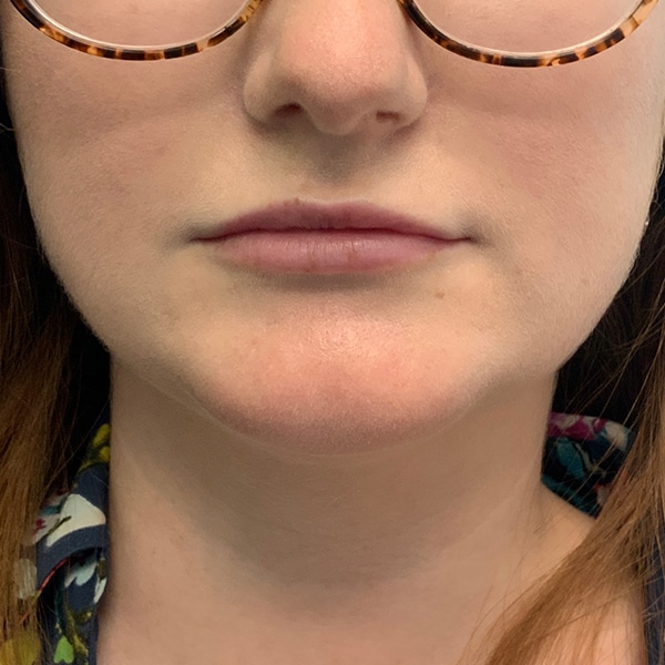 Botox® & Xeomin® 27 Before