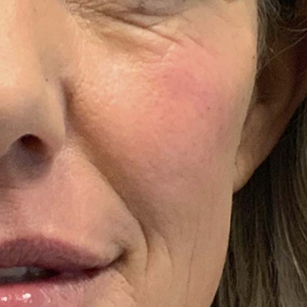 Dermal Fillers 32 After