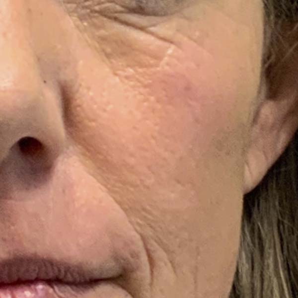 Dermal Fillers 31 Before